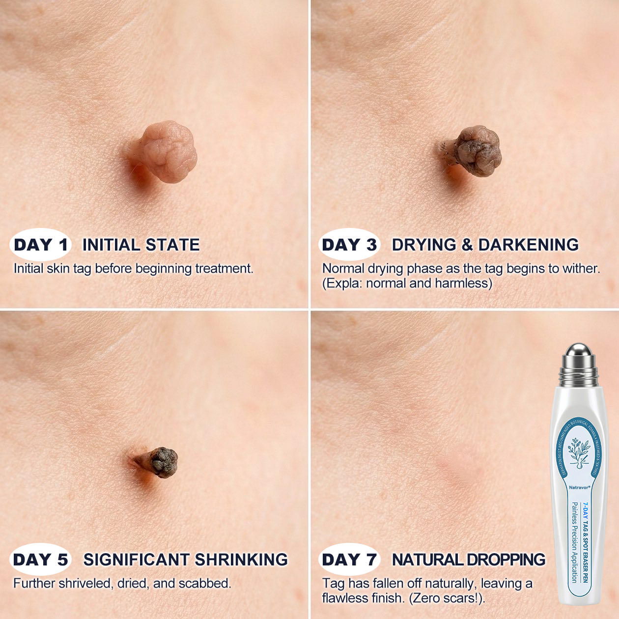 ✅𝐎𝐟𝐟𝐢𝐜𝐢𝐚𝐥 𝐁𝐫𝐚𝐧𝐝 𝐒𝐭𝐨𝐫𝐞 |✅Natravor® 7-𝐷𝑎𝑦 𝗧𝐚𝐠 & 𝗦𝗽𝐨𝐭 𝐄𝐫𝒂𝒔𝒆𝒓(Zero Pain, Zero 𝐒𝐜𝐚𝒓𝒔 Rollerball)